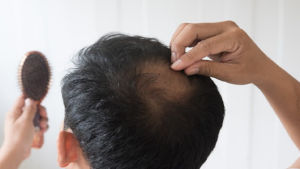 جلوگیری از ریزش مو ارثی