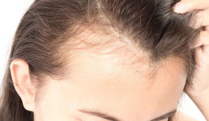 جلوگیری از ریزش مو هورمونی
